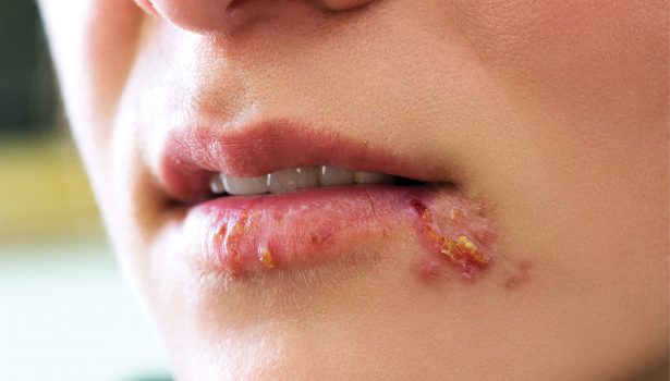 Opryszczka wargowa