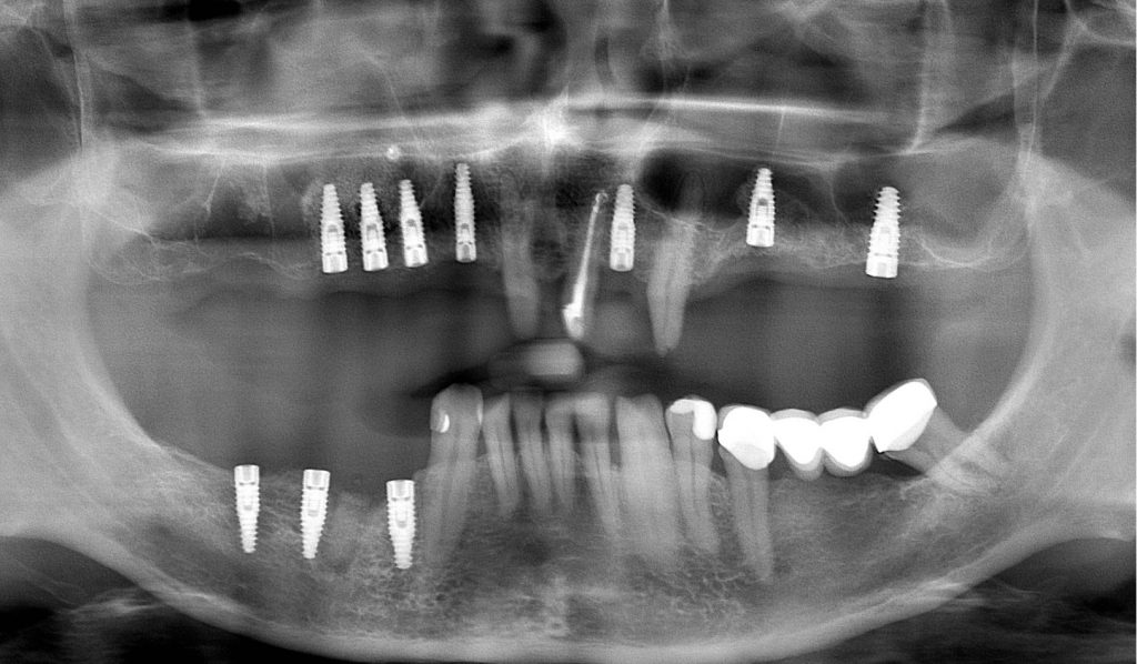 Uzupełnienie tymczasowe CAD/CAM