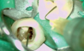 Nietypowa morfologia pierwszego zęba trzonowego