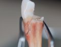 Optymalna metoda odbudowy zębów
