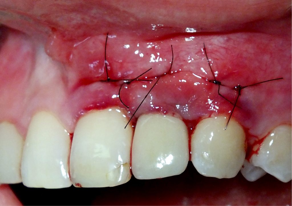 TPS_10_16_temat_numeru_AUGMENTACJA_OKOLOWSZCZEPOWYCH_TKANEK_MIEKKICH_FOT_13