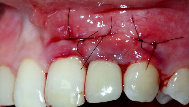 TPS_10_16_temat_numeru_AUGMENTACJA_OKOLOWSZCZEPOWYCH_TKANEK_MIEKKICH_FOT_13