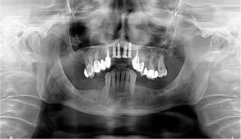 TPS_10_16_implantologia_IMPLANTACJA_MINIMALNIE_INWAZYJNA_IMPLANTOW_FOT_2