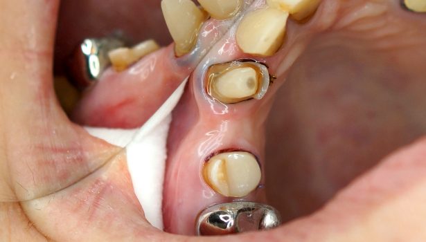 TPS_10_16_protetyka_MOST_KOMPOZYTOWY_WZMOCNIONY_WLOKNEM_SZKLANYM_FOT_4