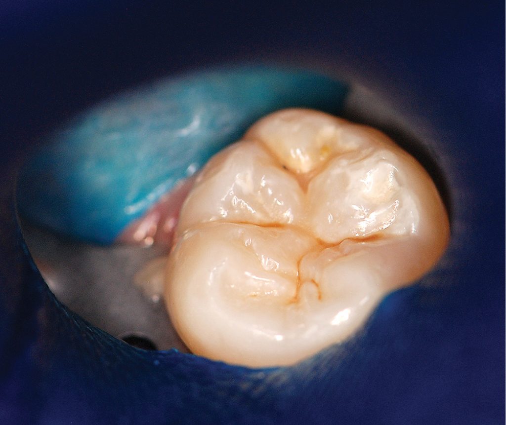 TPS_10_16_stomatologia_zachowawcza_TECHNIKA_INDYWIDUALNEGO_STEMPLA_OKLUZYJNEGO_FOT_1