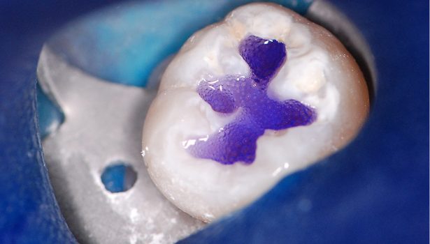 TPS_10_16_stomatologia_zachowawcza_TECHNIKA_INDYWIDUALNEGO_STEMPLA_OKLUZYJNEGO_FOT_11