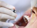Jak rozpoznać periodontopatię