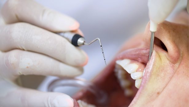Jak rozpoznać periodontopatię