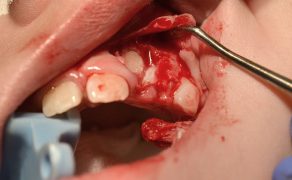 Nietypowy przypadek nadliczbowych zębów