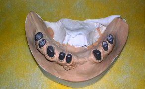 Odbudowa zębów