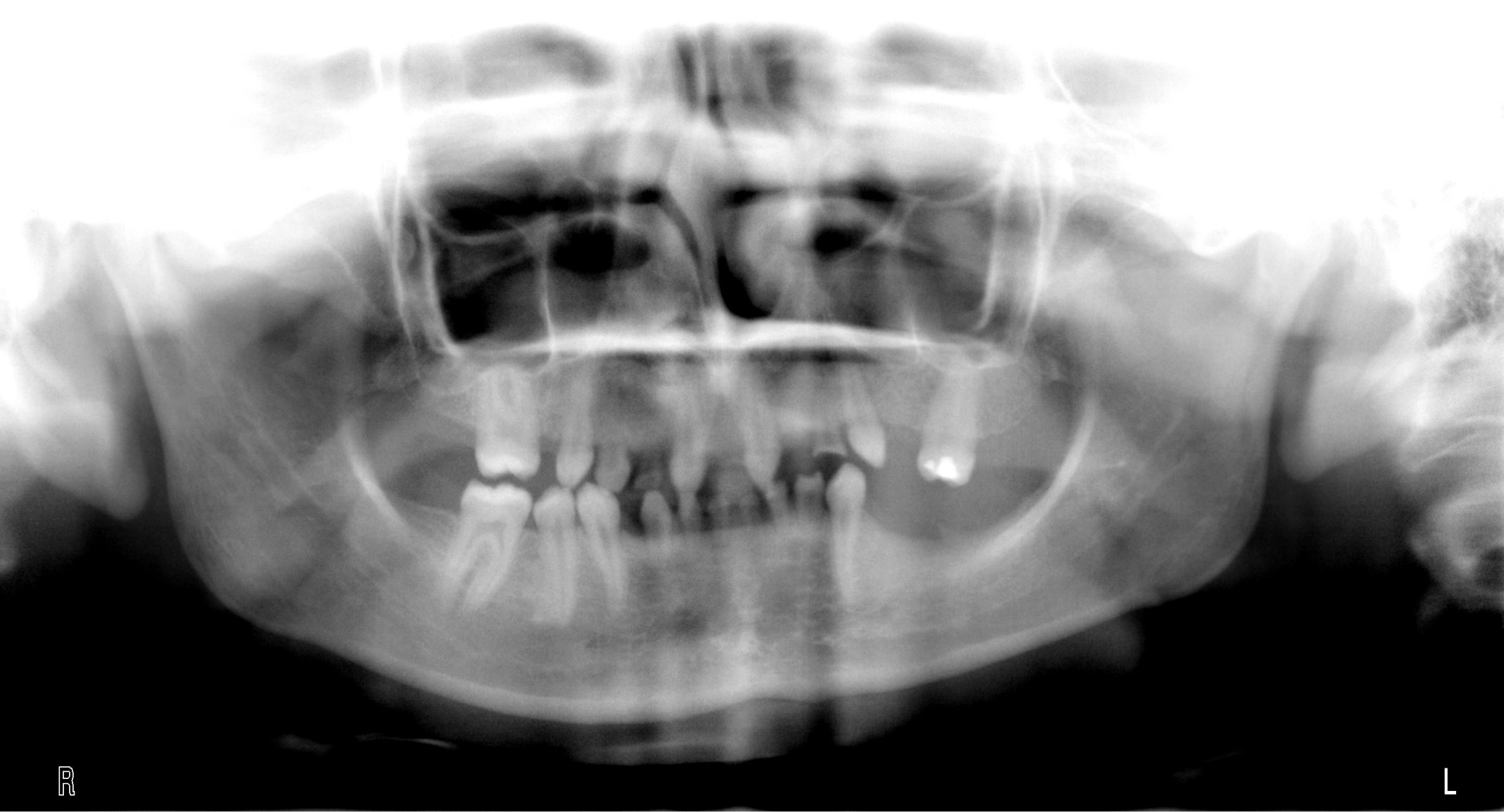 TPS_9_16_pedodoncja_PACJENTKA_Z_ZESPOLEM_DYSPLAZJI_EKTODERMALNEJ_FOT_23