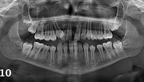 TPS_9_16_periodontologia_ZASTOSOWANIE_TERAPII_FOTODYNAMICZNEJ_FOT_1_A