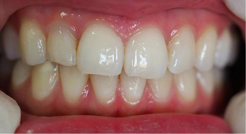 TPS_1-2_21_stomatologia_zachowawcza_ICON_NOWOCZESNA_METODA_LECZENIA_PROCHNICY_FOT_1