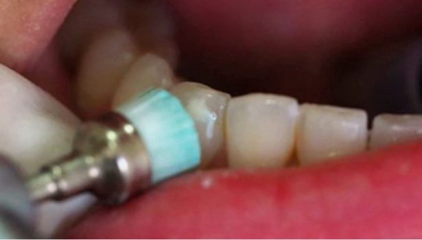 ICON – nowoczesna metoda infiltracyjna leczenia próchnicy wczesnej