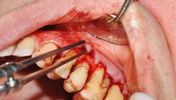 Leczenie periodontologiczne