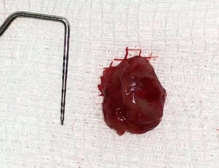 TPS_1-2_21_chirurgia_i_implantologia_MUCOCELE_DIAGNOSTYKA_I_LECZENIE_FOT_7