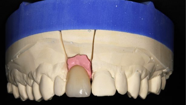 TPS_4_16_chirurgia_stomatologiczna_ATRAUMATYCZNE_METODY_EKSTRAKCJI_URZADZENIE_EXOMED_FOT_8