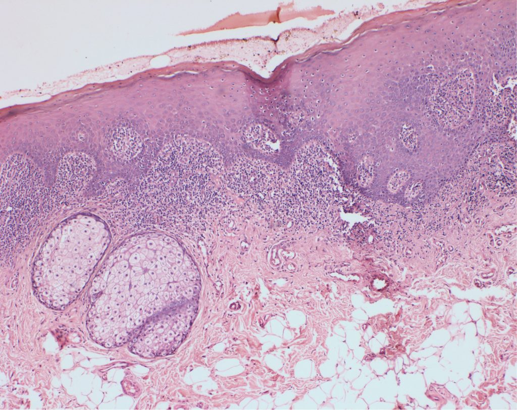 TPS_4_16_periodontologia_DIAGNOSTYKA_I_LECZENIE_LISZAJA_PLASKIEGO_FOT_1