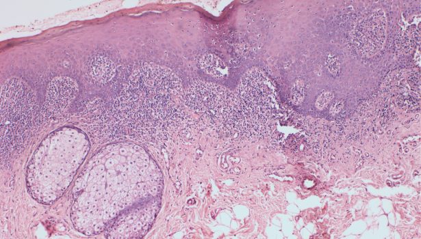 TPS_4_16_periodontologia_DIAGNOSTYKA_I_LECZENIE_LISZAJA_PLASKIEGO_FOT_1