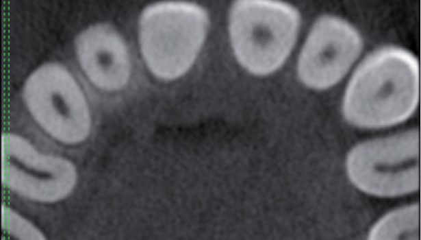 kanały korzeniowe są niedrożne
