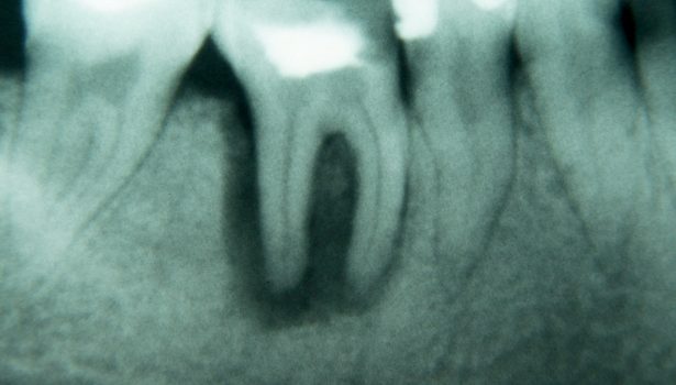 Duże zmiany okołowierzchołkowe