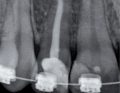 zęby leczone endodontycznie