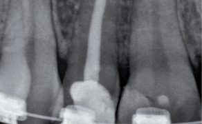 zęby leczone endodontycznie