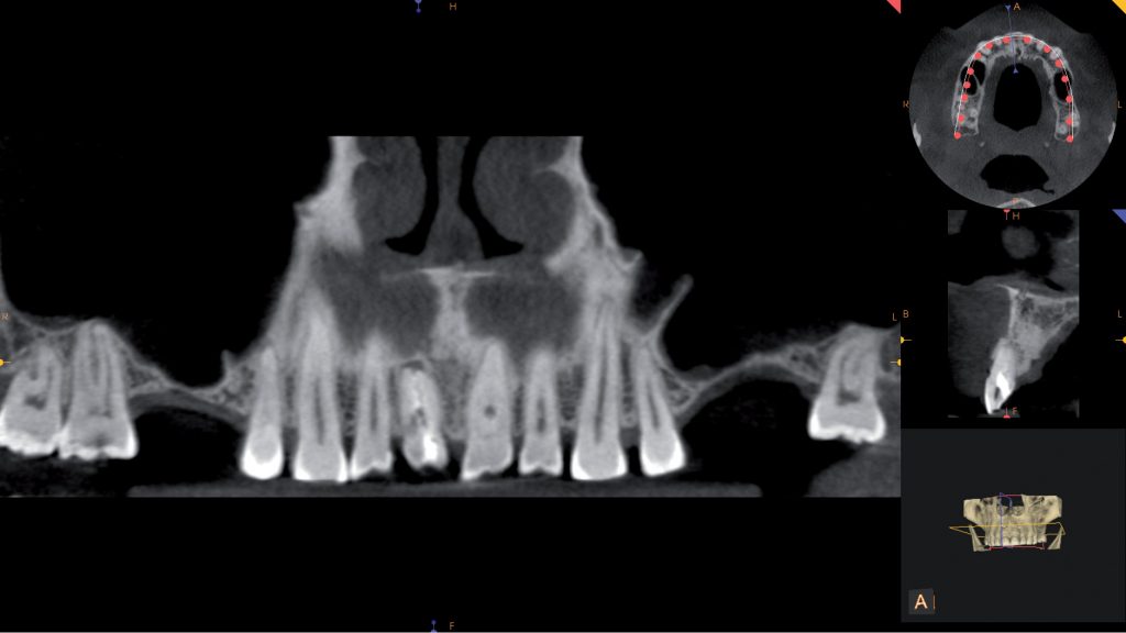 CBCT