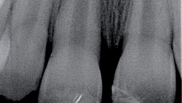 Leczenie chorób miazgi zębów