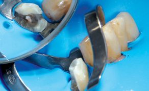 adhezyjna odbudowa zrębu zęba