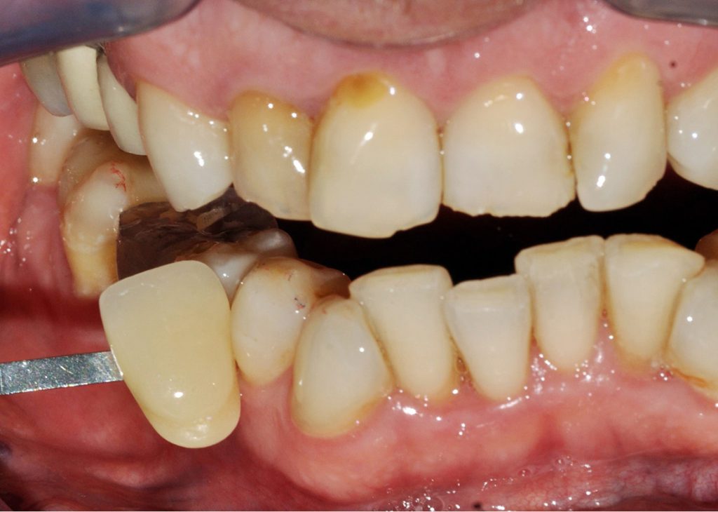 TPS_3-4_21_chirurgia_i_implantologia_AUGMENTACJA_TKANEK_MIEKKICH_FOT_9