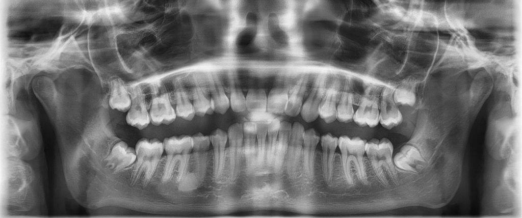 TPS_3-4_21_ortodoncja_LECZENIE_ORTODONTYCZNE_APARATAMI_STALYMI_FOT_2