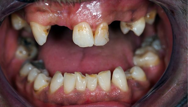 Tymczasowa rehabilitacja zwarcia