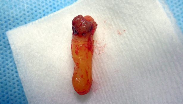 piezosurgery