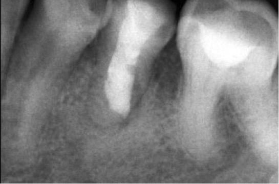 TPS_3-4_21_stomatologia_zachowawcza_ZAMYKANIE_PERFORACJI_Z_ZASTOSOWANIEM_MTA_FOT_5