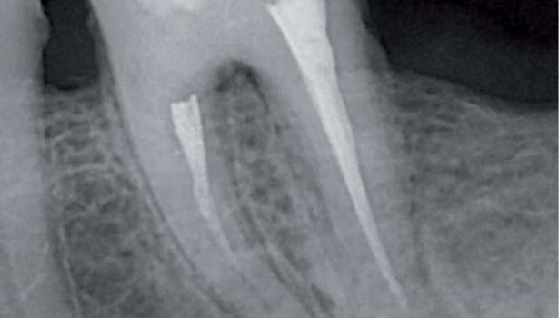 EWP_4_14_lopuszynska_zarzecka_KONGLOMERAT_MTA_LECZENIE_KANALOWE_RYC_10