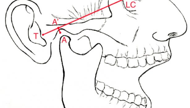 Analiza przebiegu artrocentezy stawu skroniowo-żuchwowego