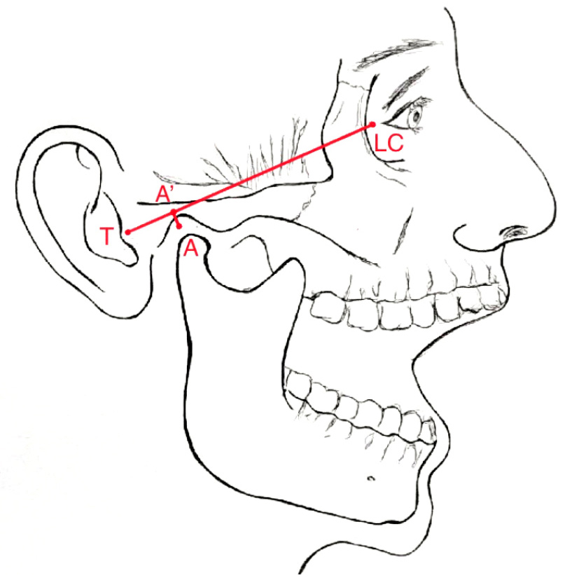 Analiza przebiegu artrocentezy stawu skroniowo-żuchwowego