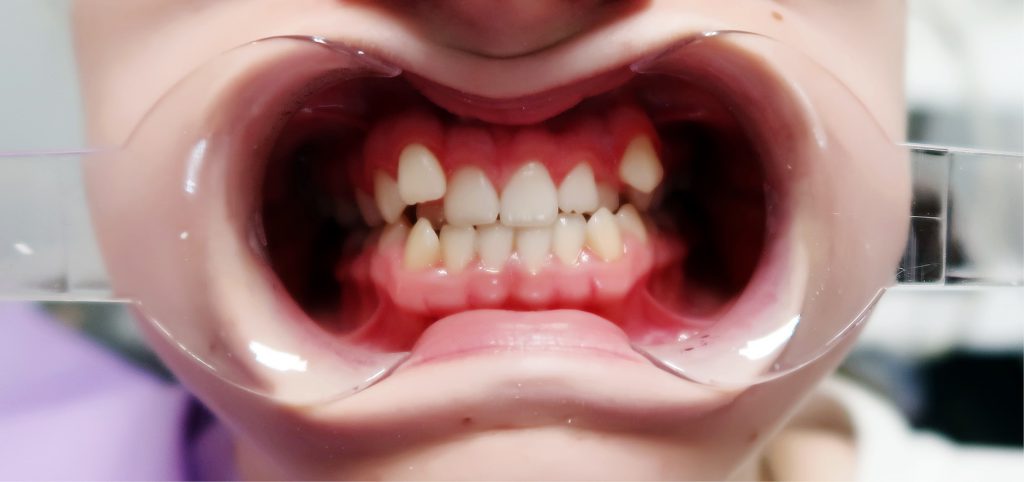 Dodatkowe zęby sieczne boczne w szczęce – opis przypadku