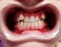 Dodatkowe zęby sieczne boczne w szczęce – opis przypadku
