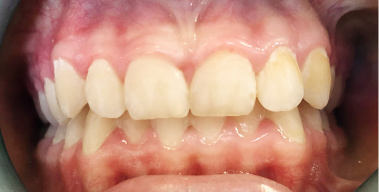 TPS_5_21_stomatologia_zachowawcza_z_endodoncja_ICON_DMG_RYC_6