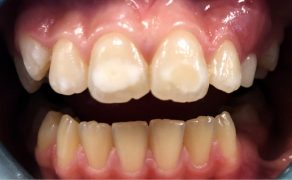 leczenie hipermineralizacji zębów