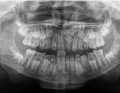 Zdjęcie pantomograficzne z widocznym zębem dodatkowym w okolicy 21