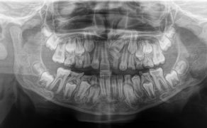 Zdjęcie pantomograficzne z widocznym zębem dodatkowym w okolicy 21