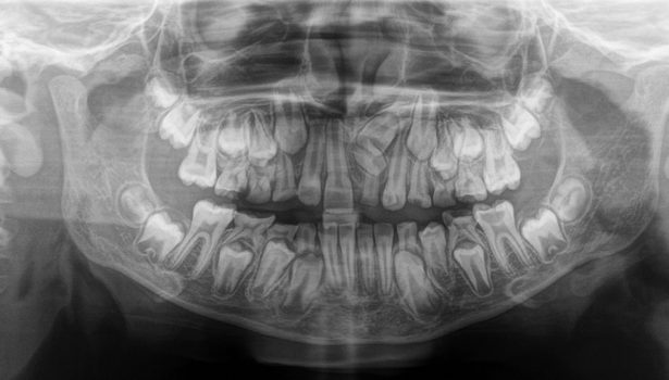 Zdjęcie pantomograficzne z widocznym zębem dodatkowym w okolicy 21