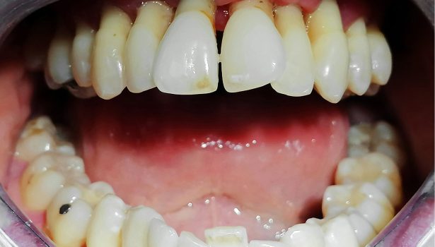 Zapalenie przyzębia w przebiegu neutropenii cyklicznej