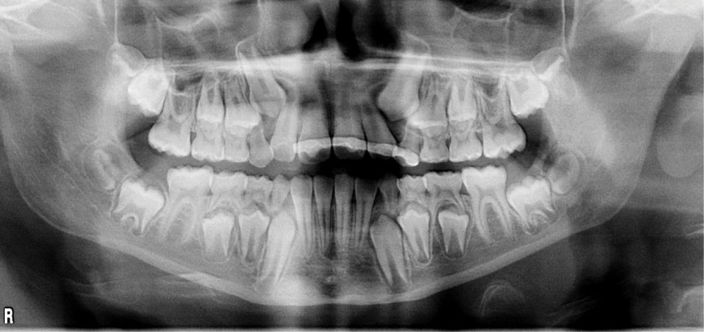 TPS_5_21_stomatologia_wieku_rozwojowego_ZWICHNIECIE_CALKOWITE_SIEKACZA_FOT_2