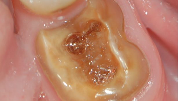 leczenie zachowawcze resorpcji wewnętrznej