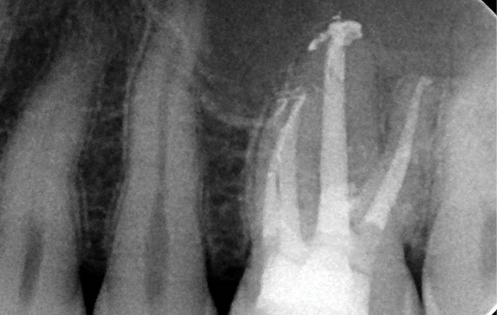 EWP_3_14_slawomir_gabrys_ZAOPATRYWANIE_PERFORACJI_PREPARATEM_MTA_RYC_38