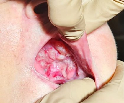 Splot Batsona - aspekty kliniczne i anatomiczne